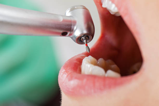 Best Emergency Tooth Extraction in Limon, CO